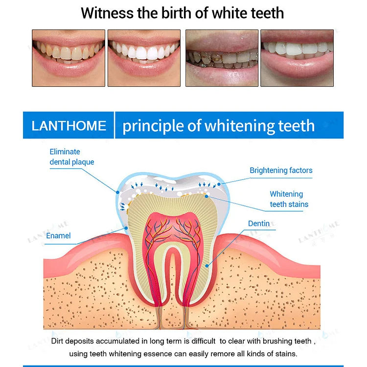 TeethWhip™ - Essence For Teeth Whitening (50% OFF) 