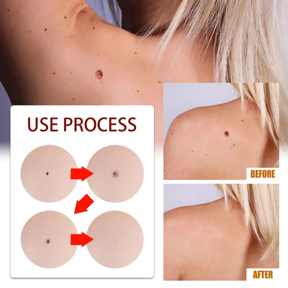 Candice™ - Dark Spot Removal Formula (1+1 FREE!) 