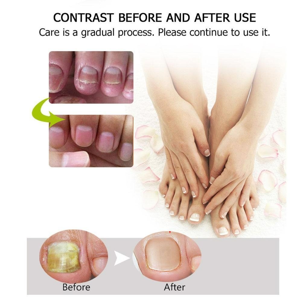 Nail Repair | Fast and effective results! 1+1 FREE!